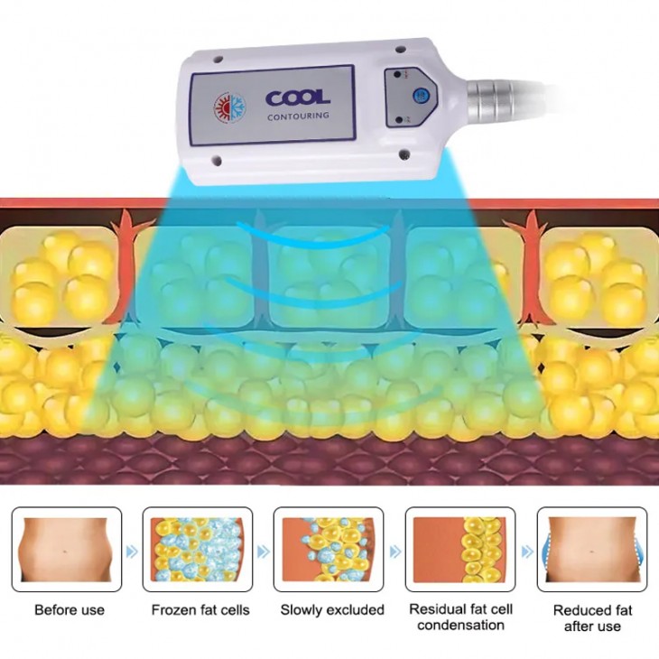 Aparat Criolipoliza palete criogenice, Cryo-Plates EMS RF Criolipoliză Conturarea Corpului, Pierdere în Greutate Cool Conturing 4 aplicatori
