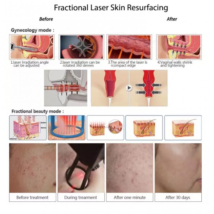 Aparat Laser Fractional Co2 60W 10600nm Skin Resurfacing Lifting, Indepartare Vergeturi, Cicatrici, Anti Acnee, Intretinere 