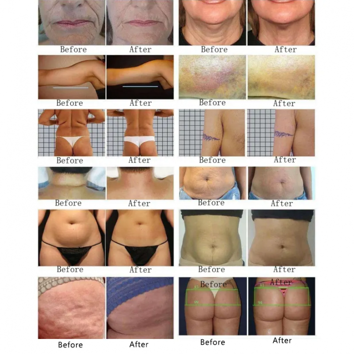 Aparat remodelare si Facial Portabil 4in1 Vaccum Rotativ Negative Pressure RF Machine, Pierdere in greutate, Body Slimming, Skin Lifting, Skin Firming